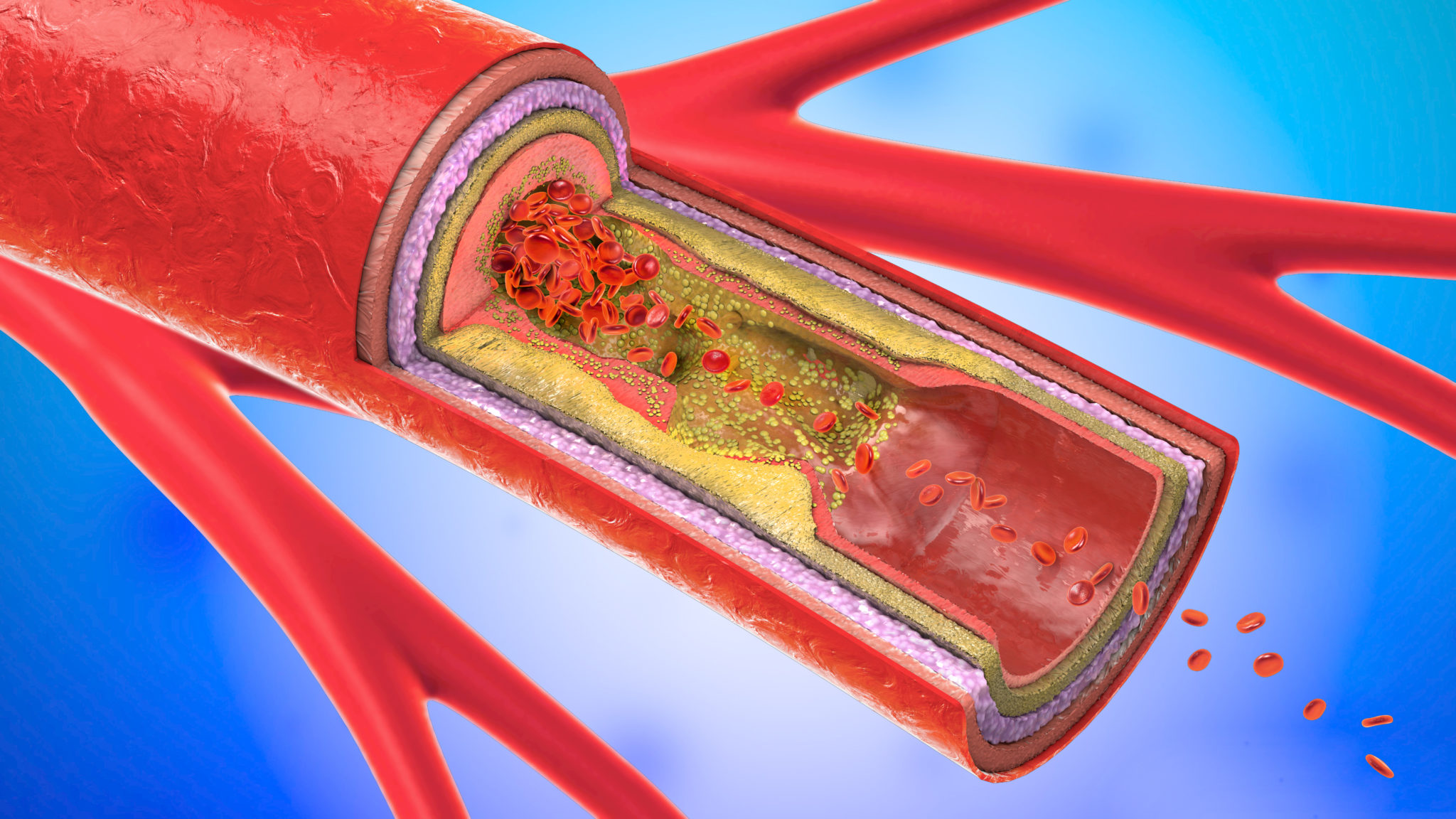 is-carotid-artery-disease-treatable-life-line-screening